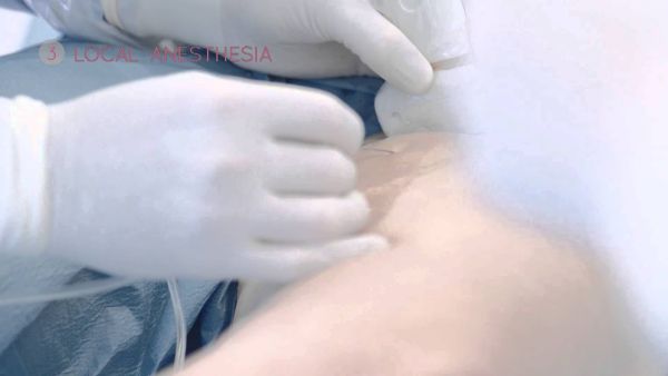 elves radialring e endophlebike