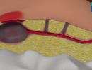 silac r h therapeia tes kystes