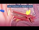 animation laevita gynecology by