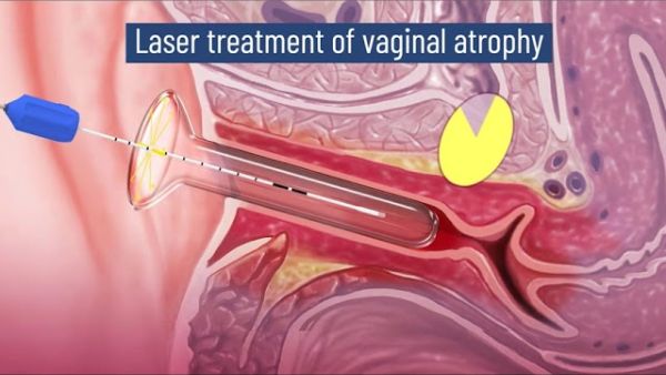 animation laevita gynecology by