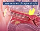 animation laevita gynecology by