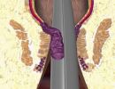 aimorroidoplastike lhp r e