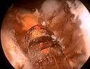 biolitec r medical laser laser use