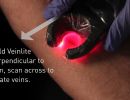 veinlite led vein finder demo
