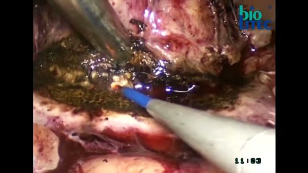 biolitec r medical laser